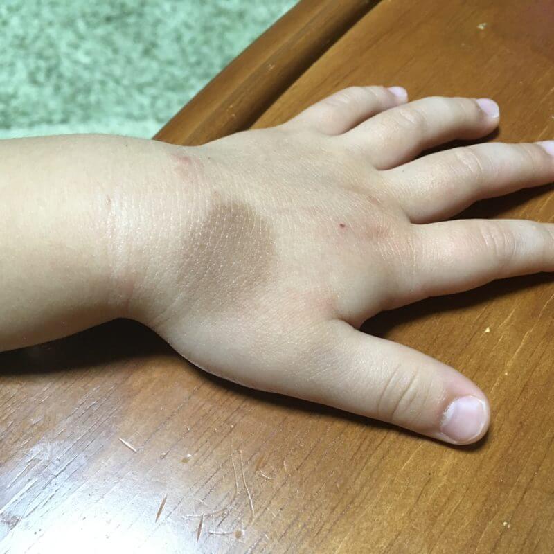 赤ちゃんの蒙古斑｜異所性蒙古斑は成長するとどうなる？