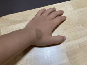 手の蒙古斑5歳